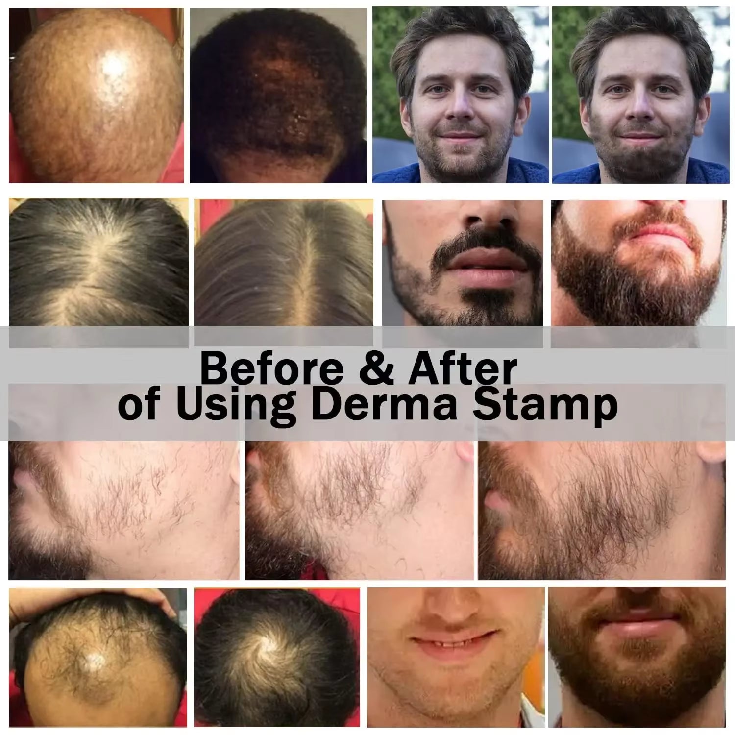 RevitaNeedle 120-Pin Derma Stamp