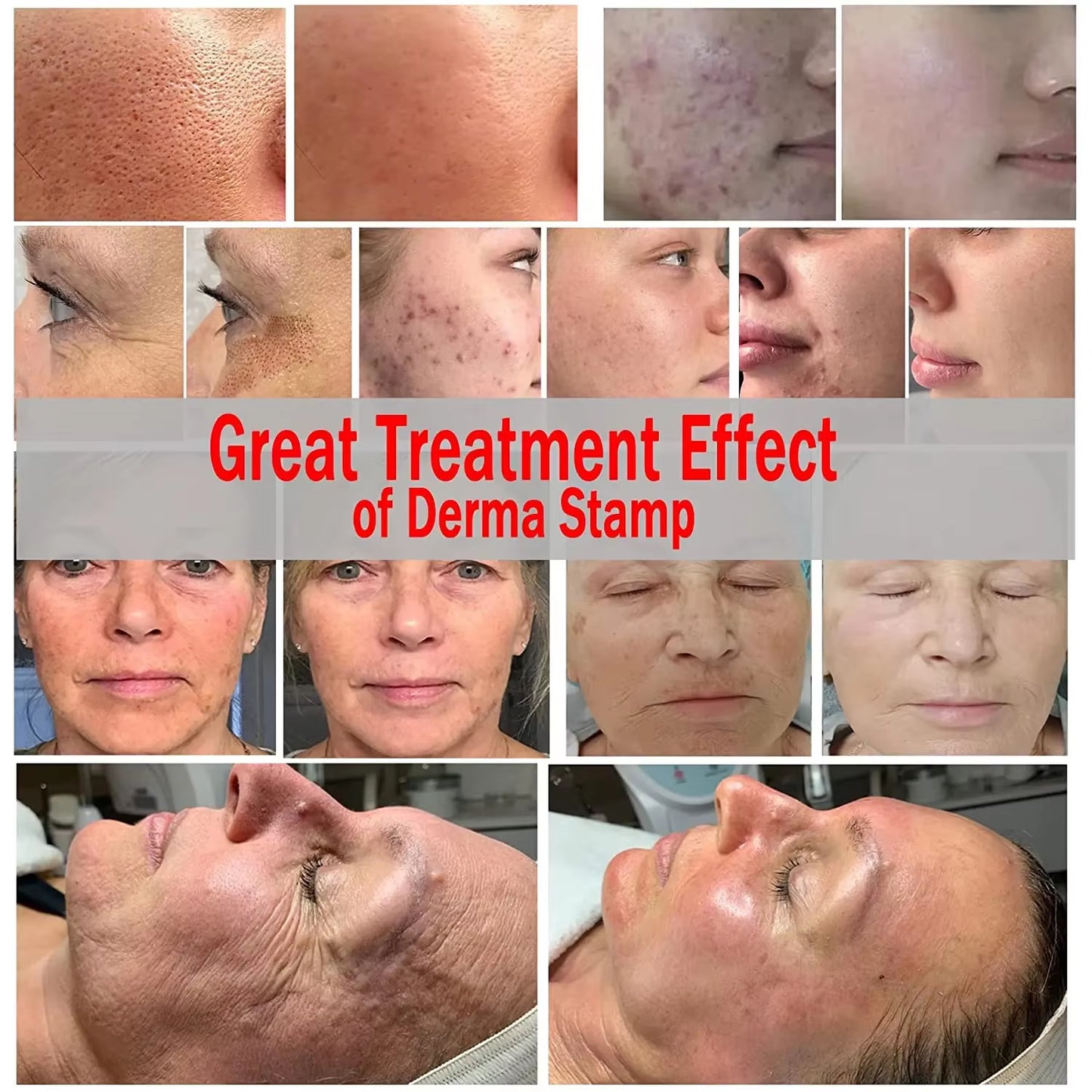 RevitaNeedle 120-Pin Derma Stamp