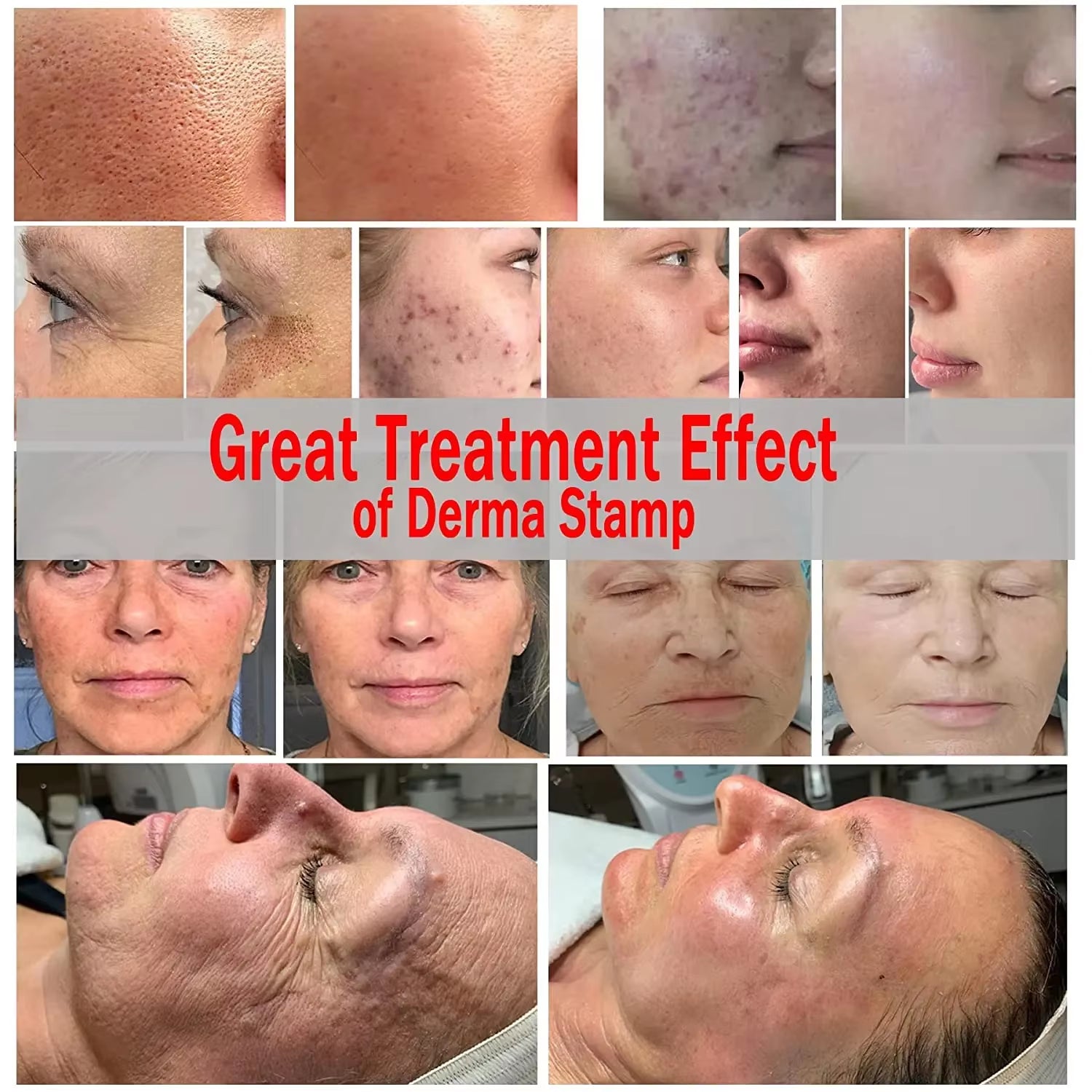 RevitaNeedle 120-Pin Derma Stamp